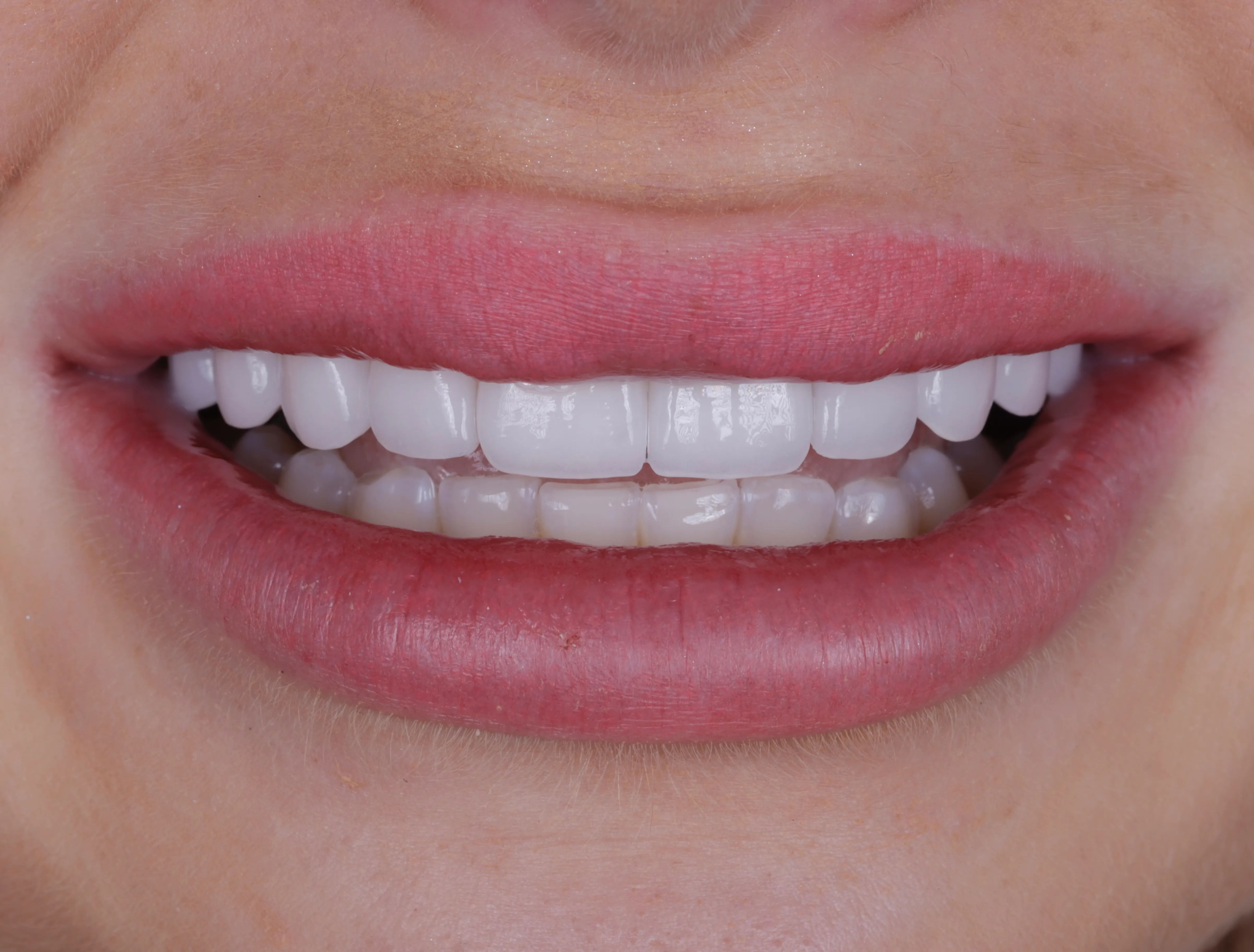 After no prep veneers smile makeover patient one