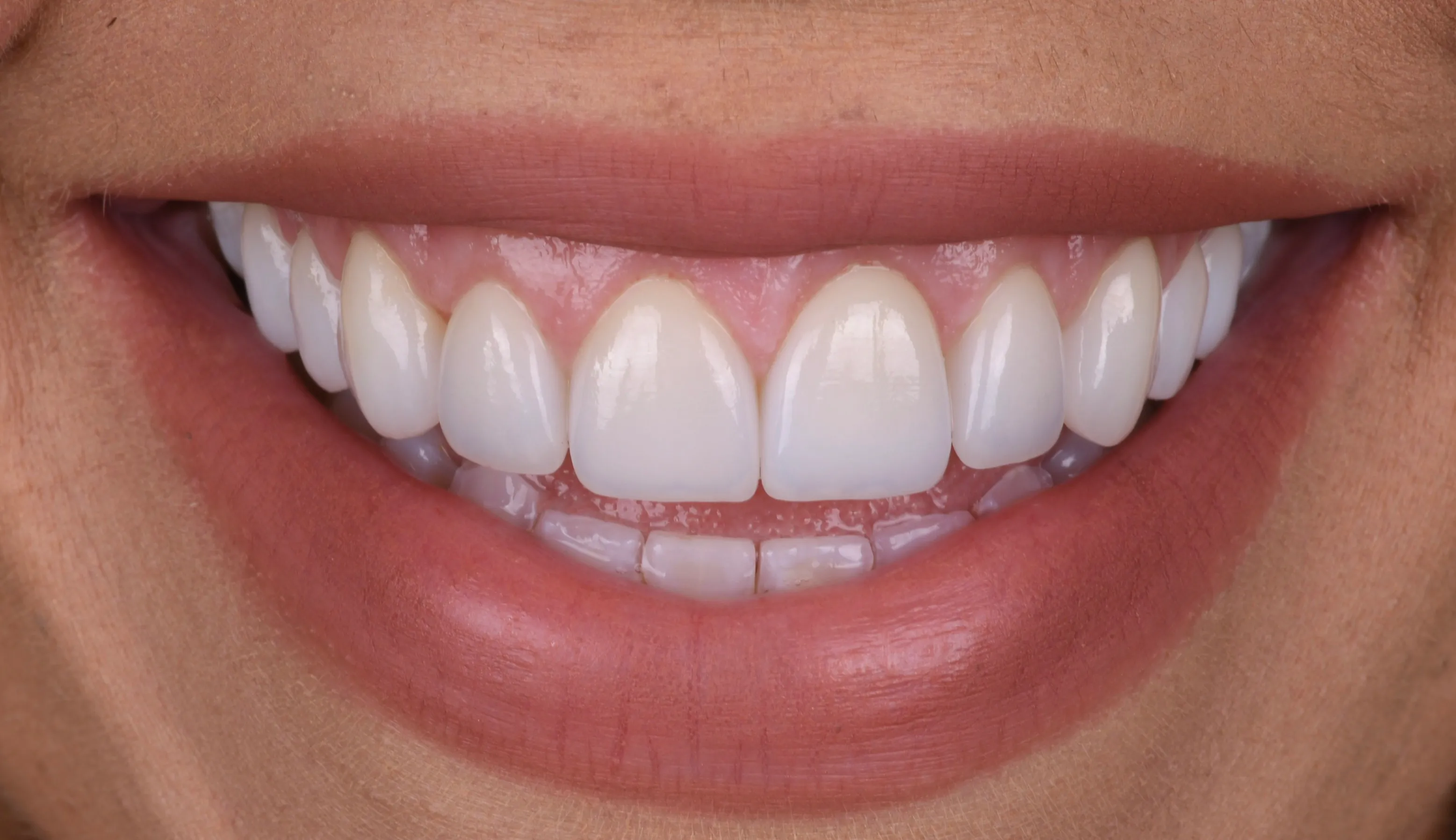 After minimal prep veneers smile makeover patient two