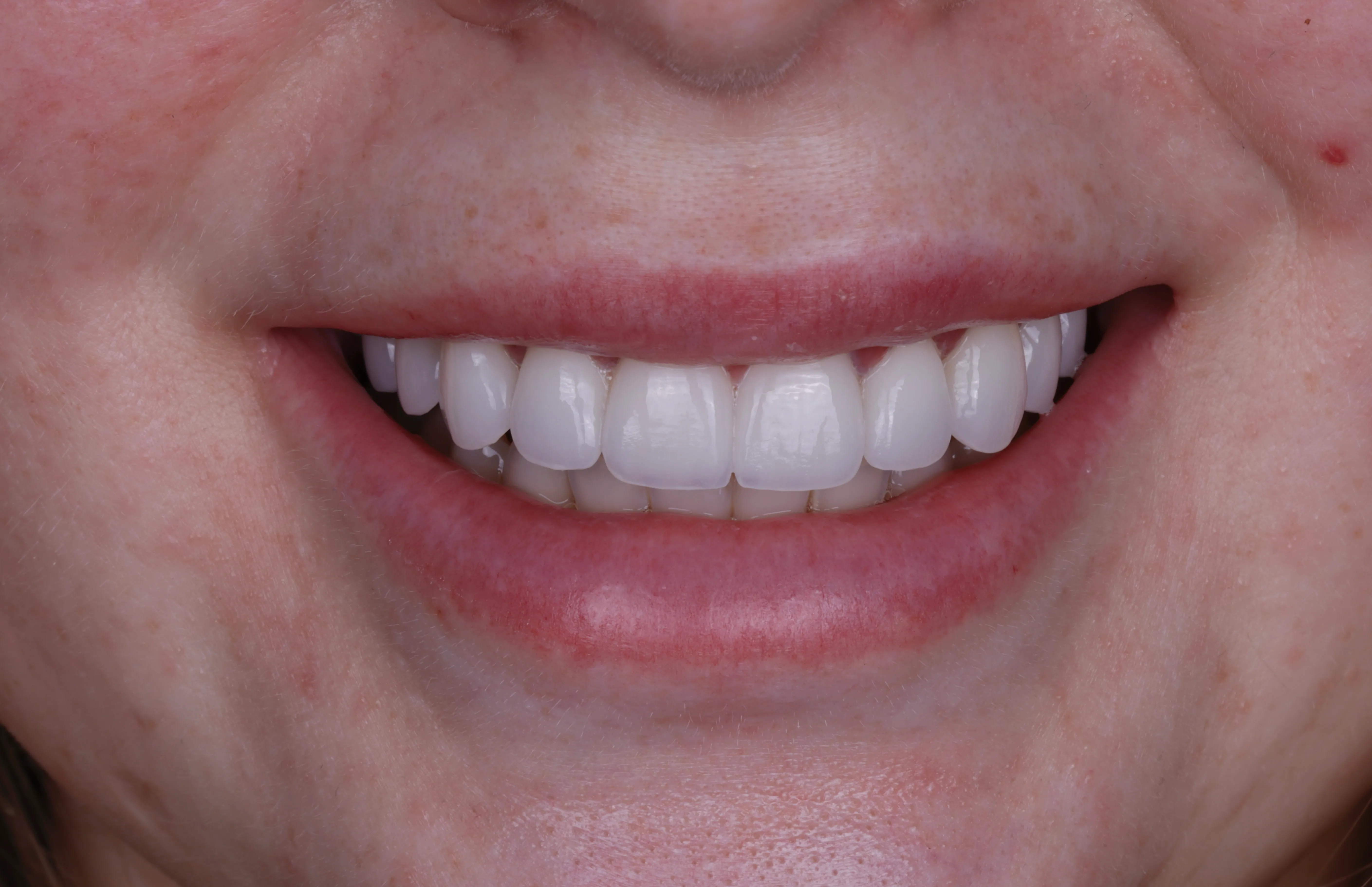 After porcelain veneers smile makeover patient three