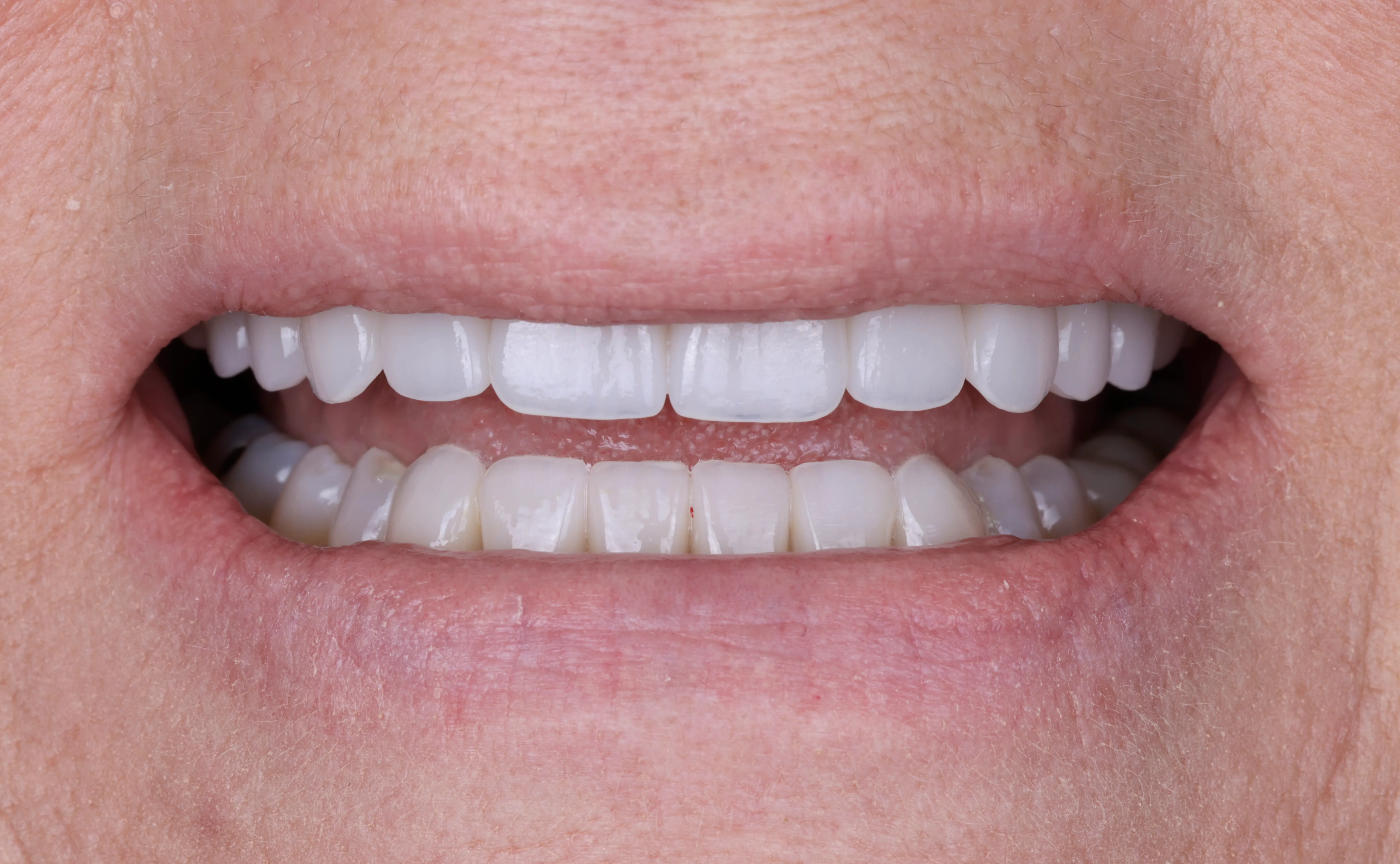 After close up showing repaired refined porcelain veneer smile design