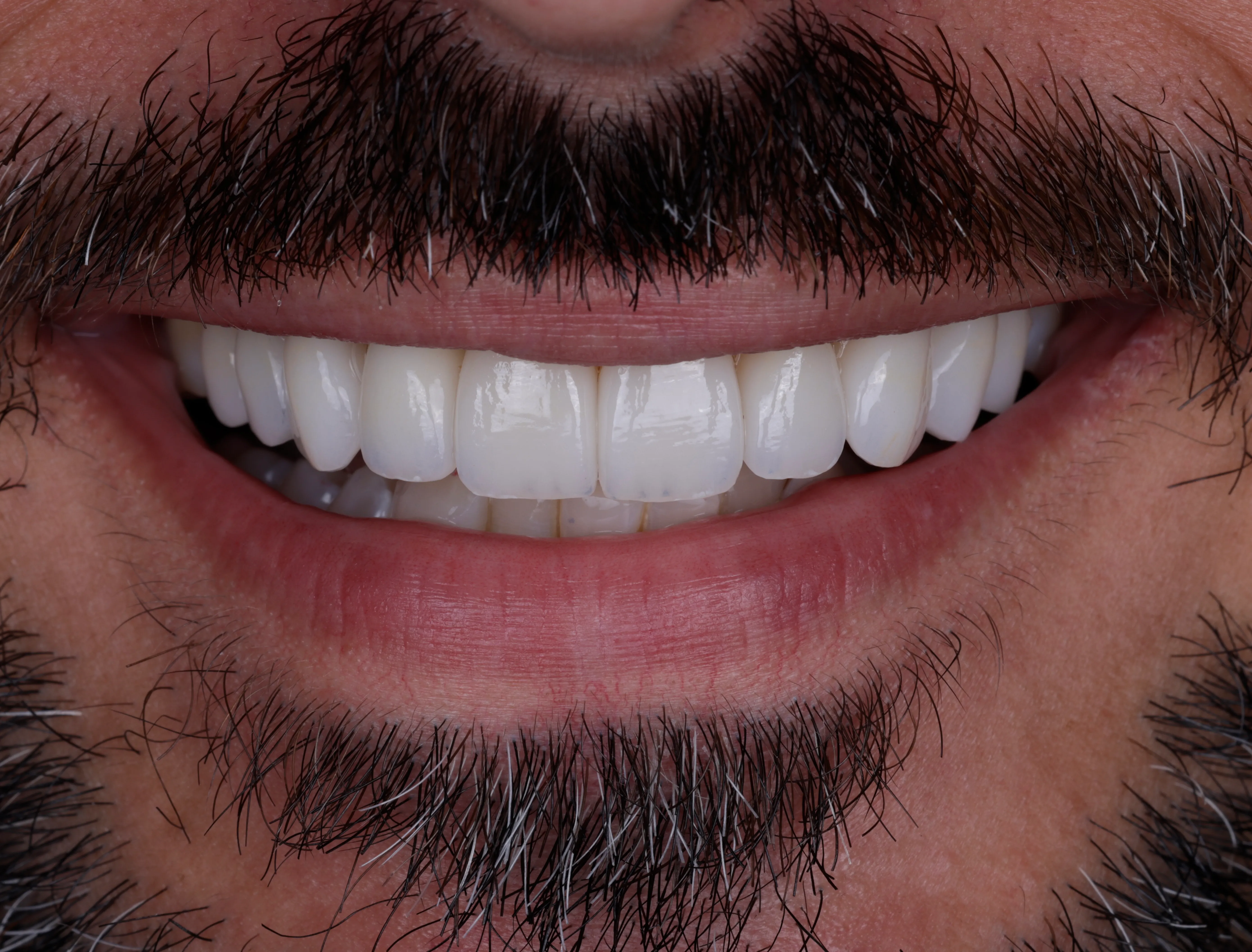 After close up showing natural masculine porcelain veneer smile design