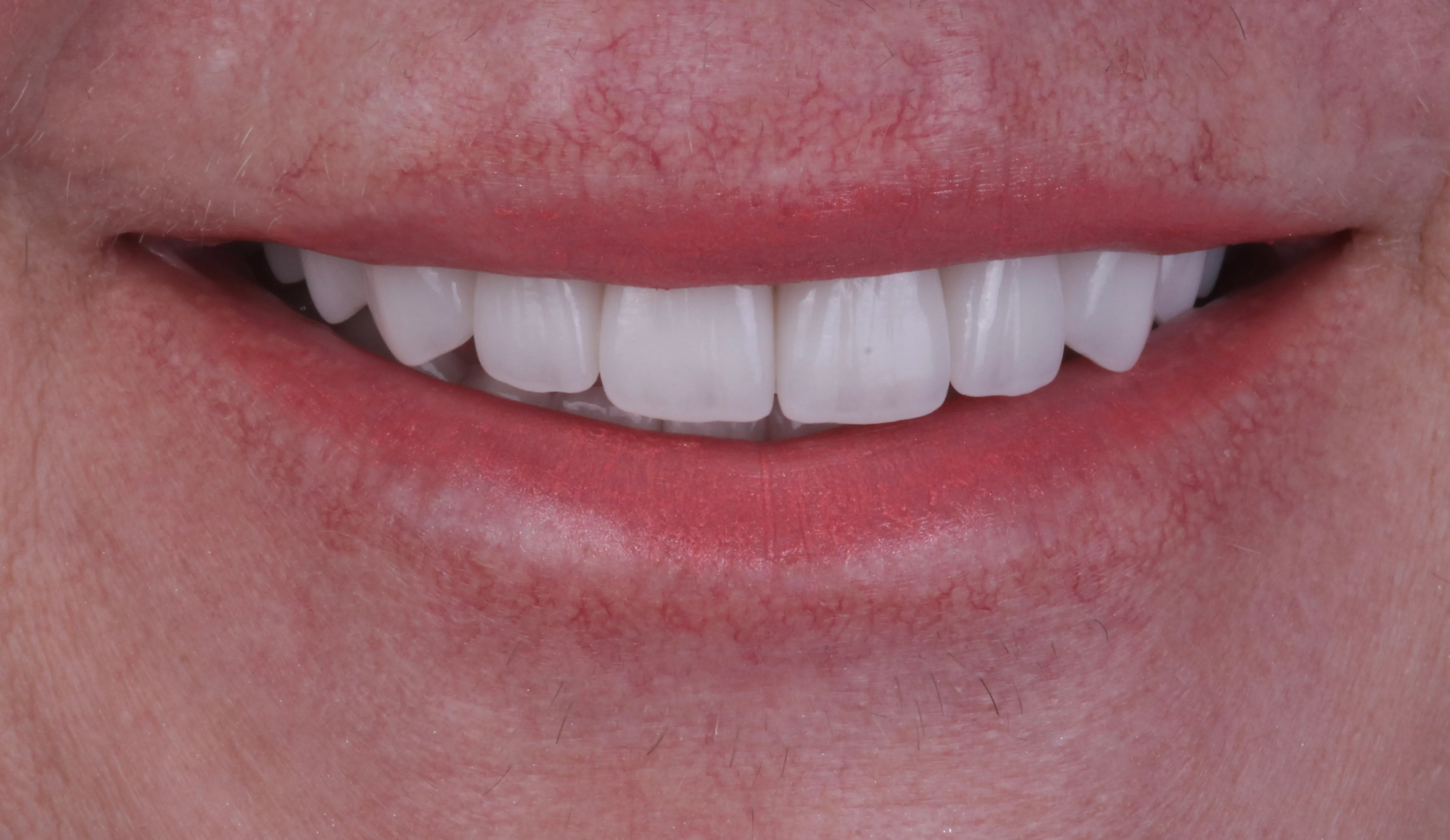 After close up showing brighter porcelain veneers with improved symmetry and natural proportions