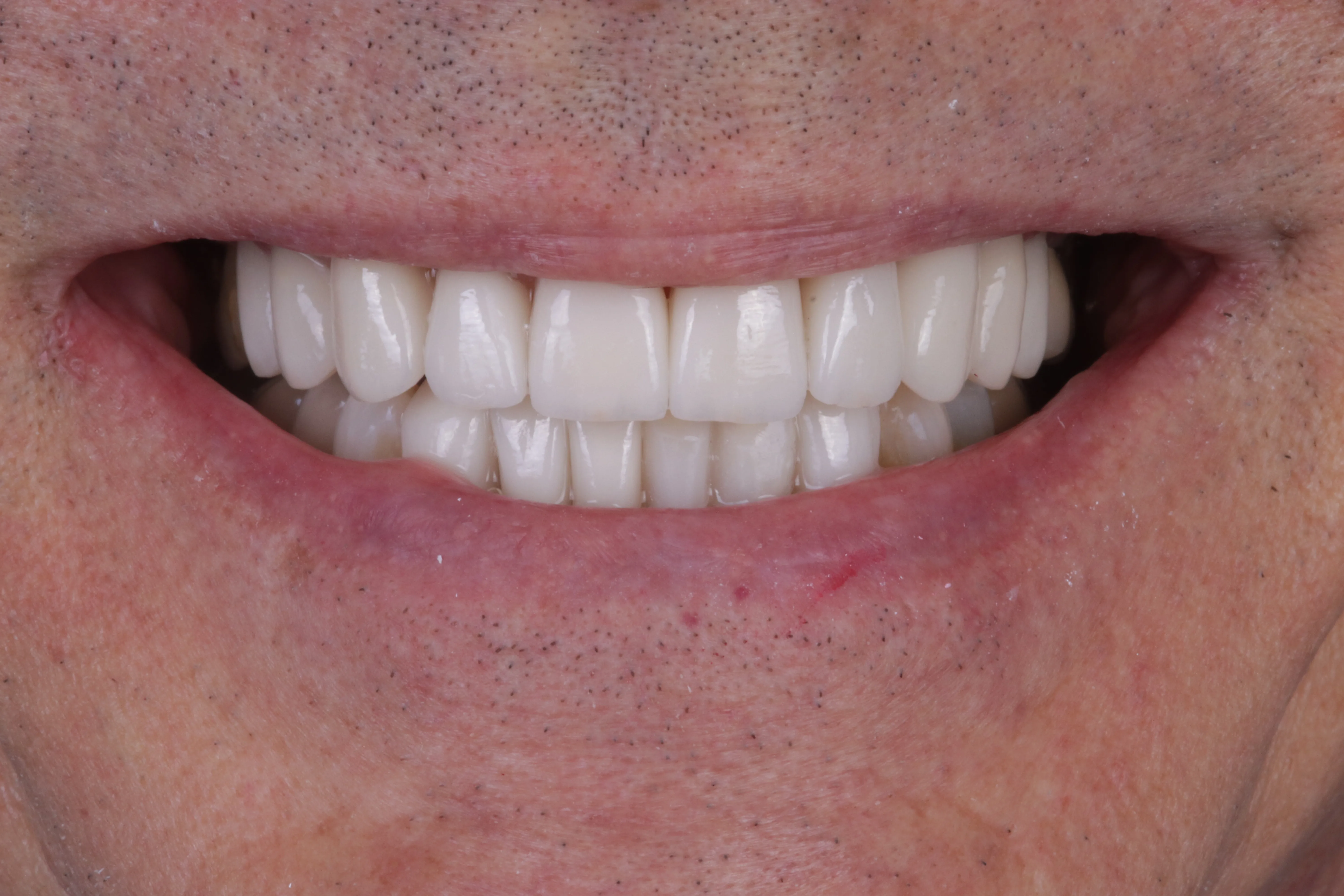 After close up showing dramatic porcelain veneer smile makeover with improved balance and confidence