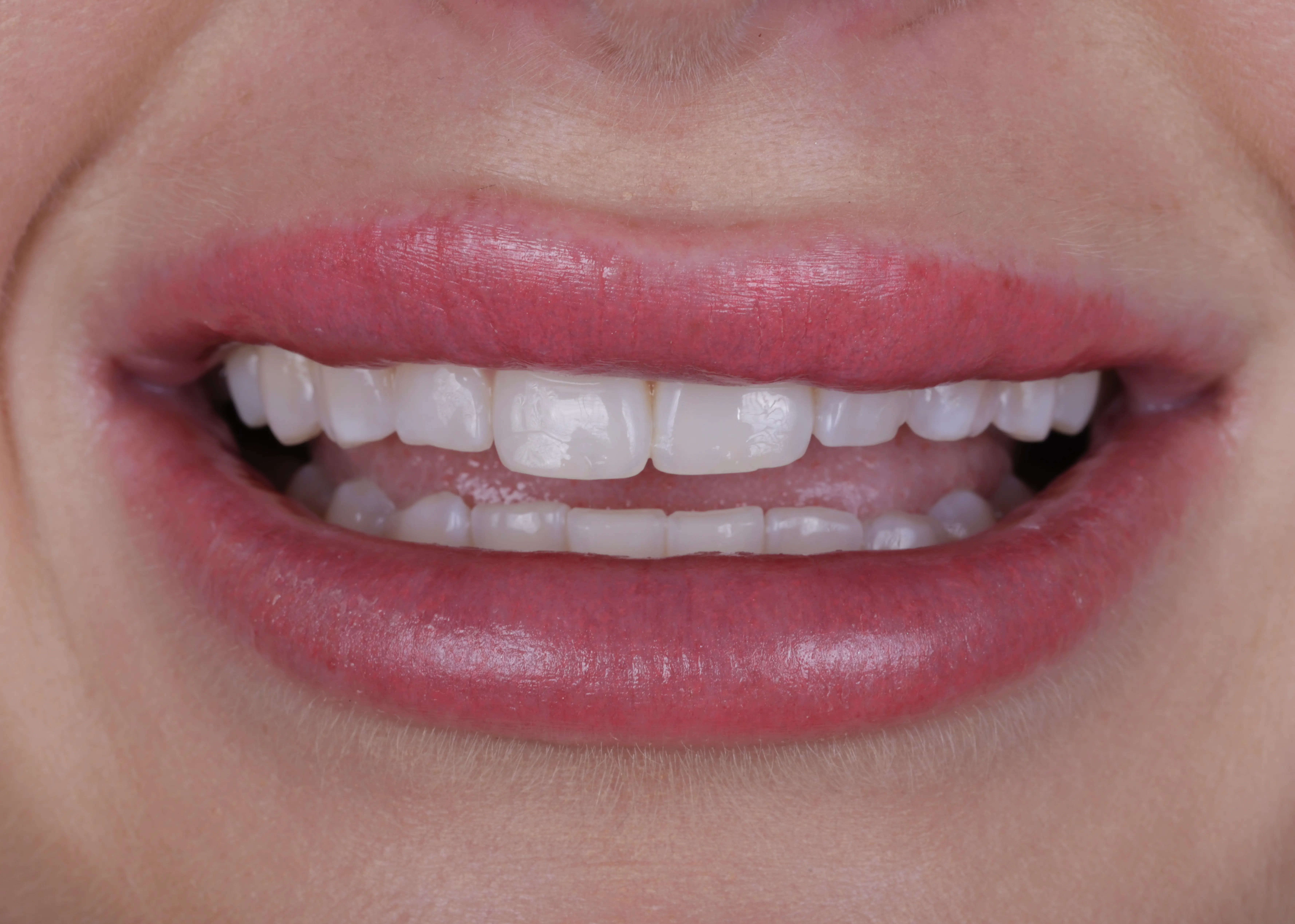 Before no prep veneers smile makeover patient one