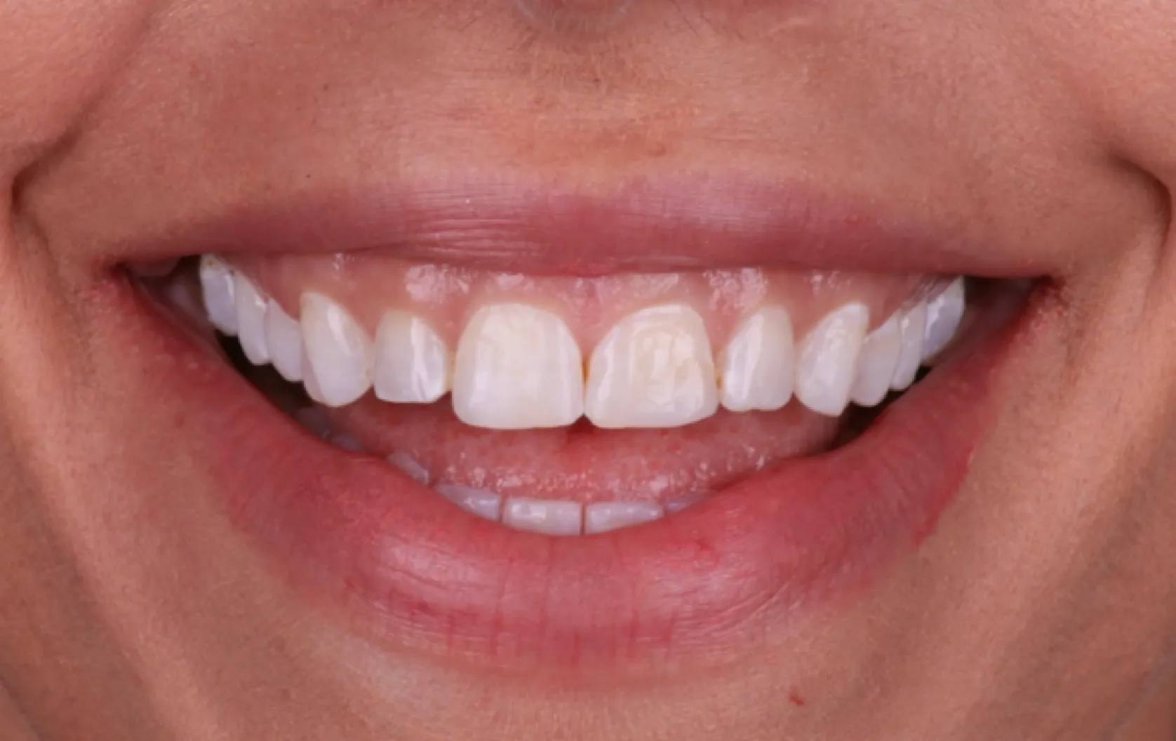 Before minimal prep veneers smile makeover patient two