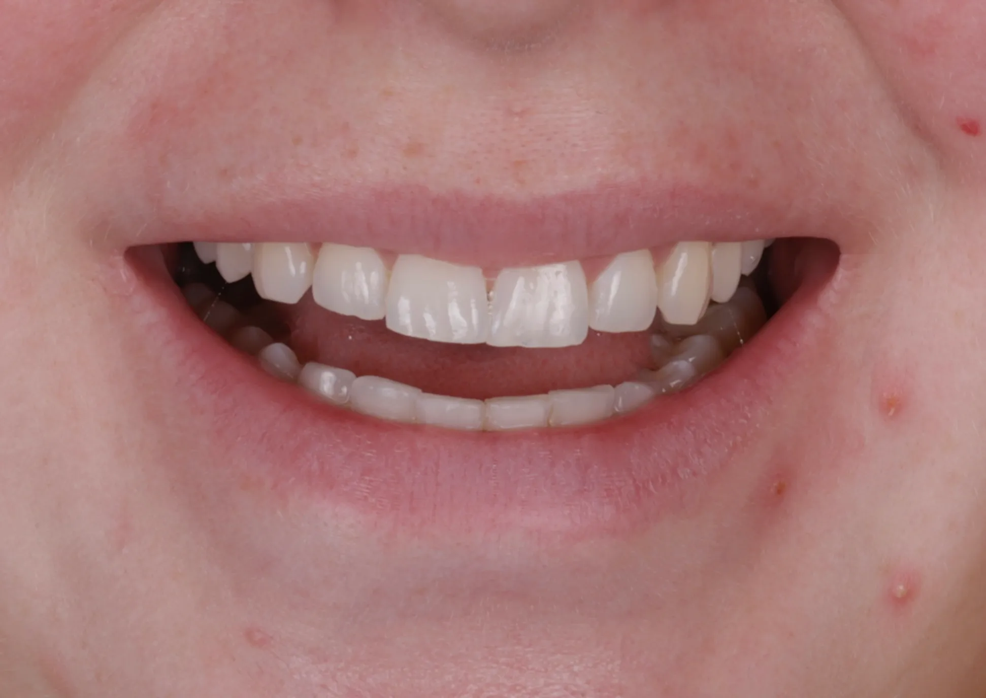 Before porcelain veneers smile makeover patient three