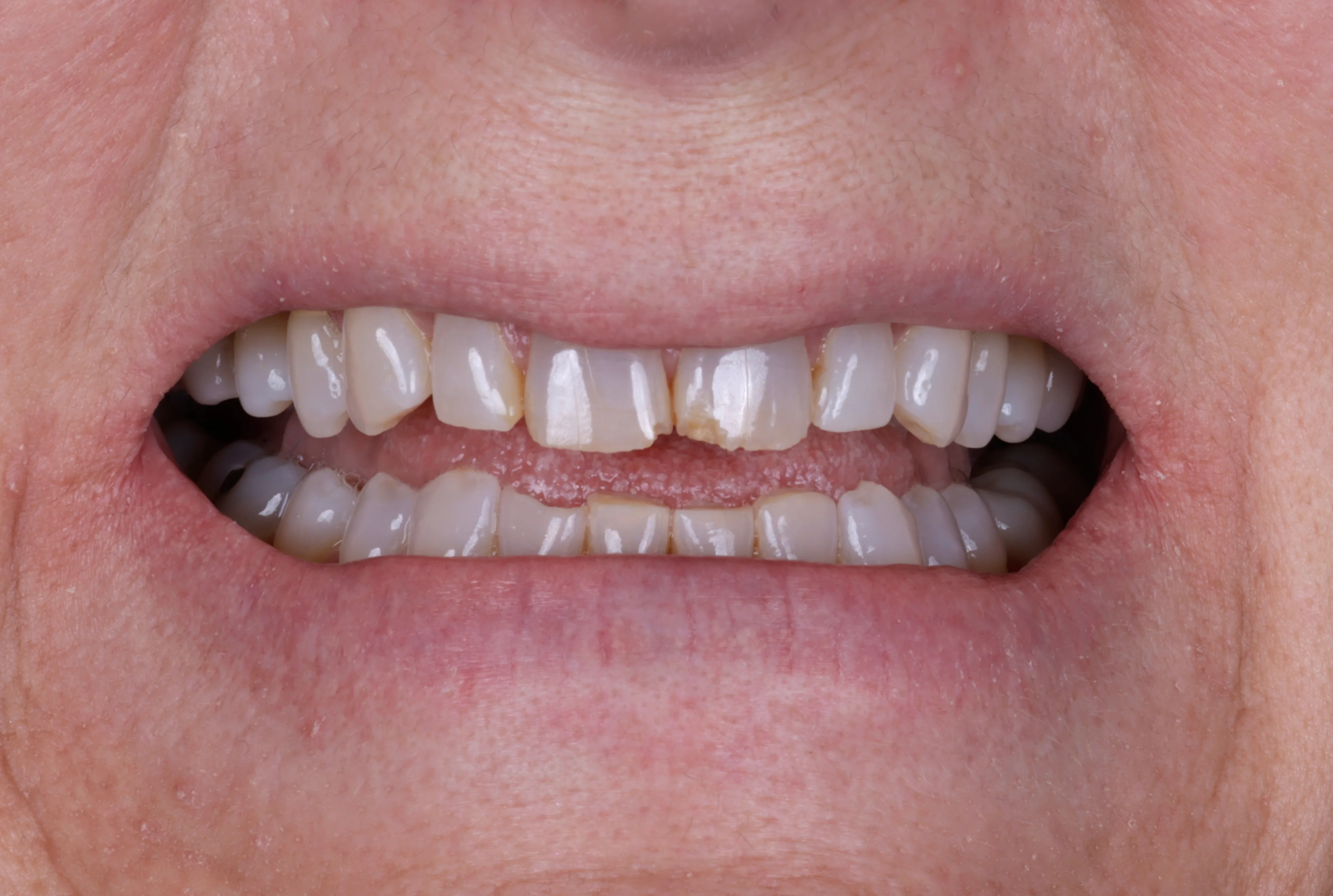Before close up showing chipped worn front teeth before porcelain veneers
