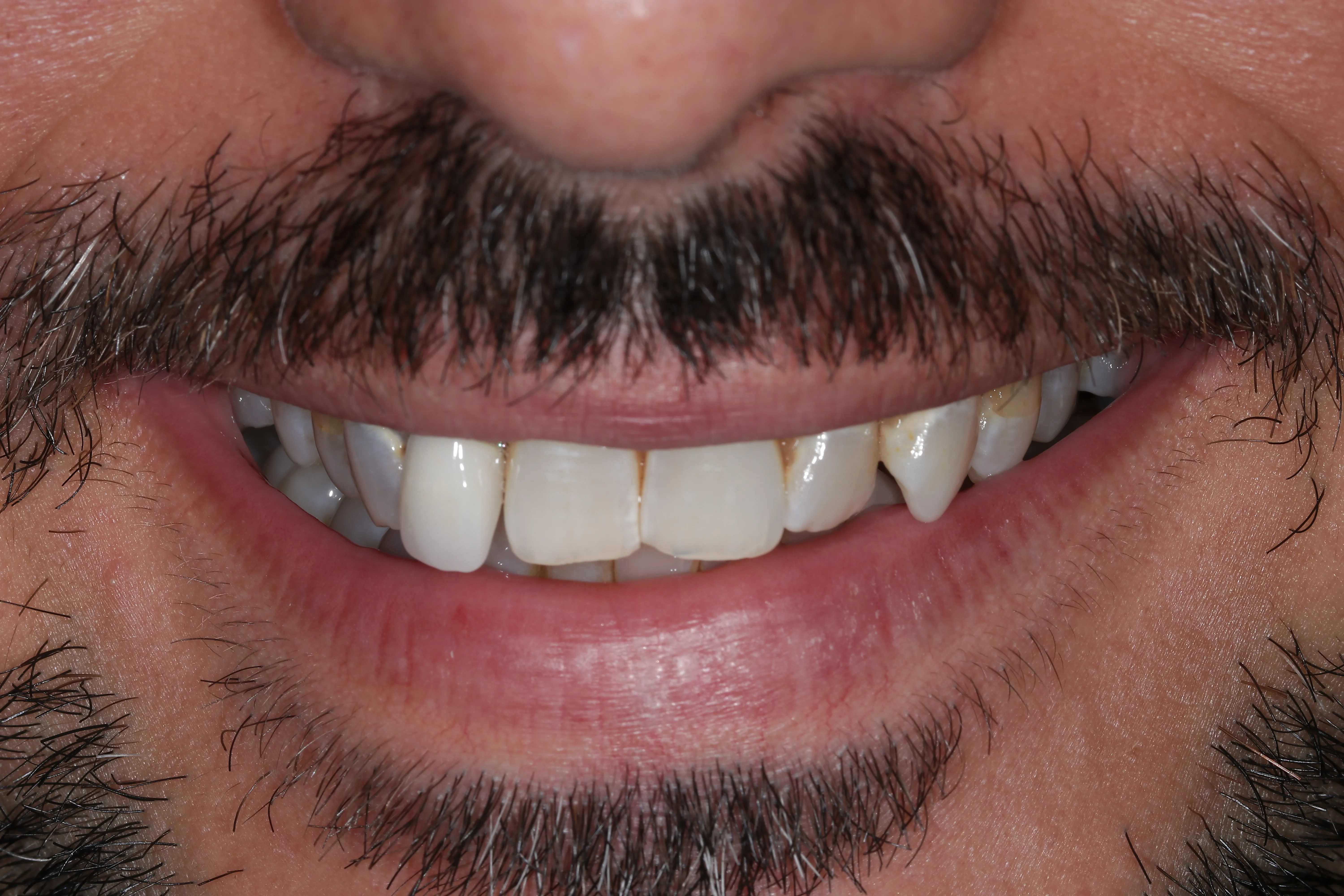 Before close up showing uneven front teeth and tooth position before porcelain veneers