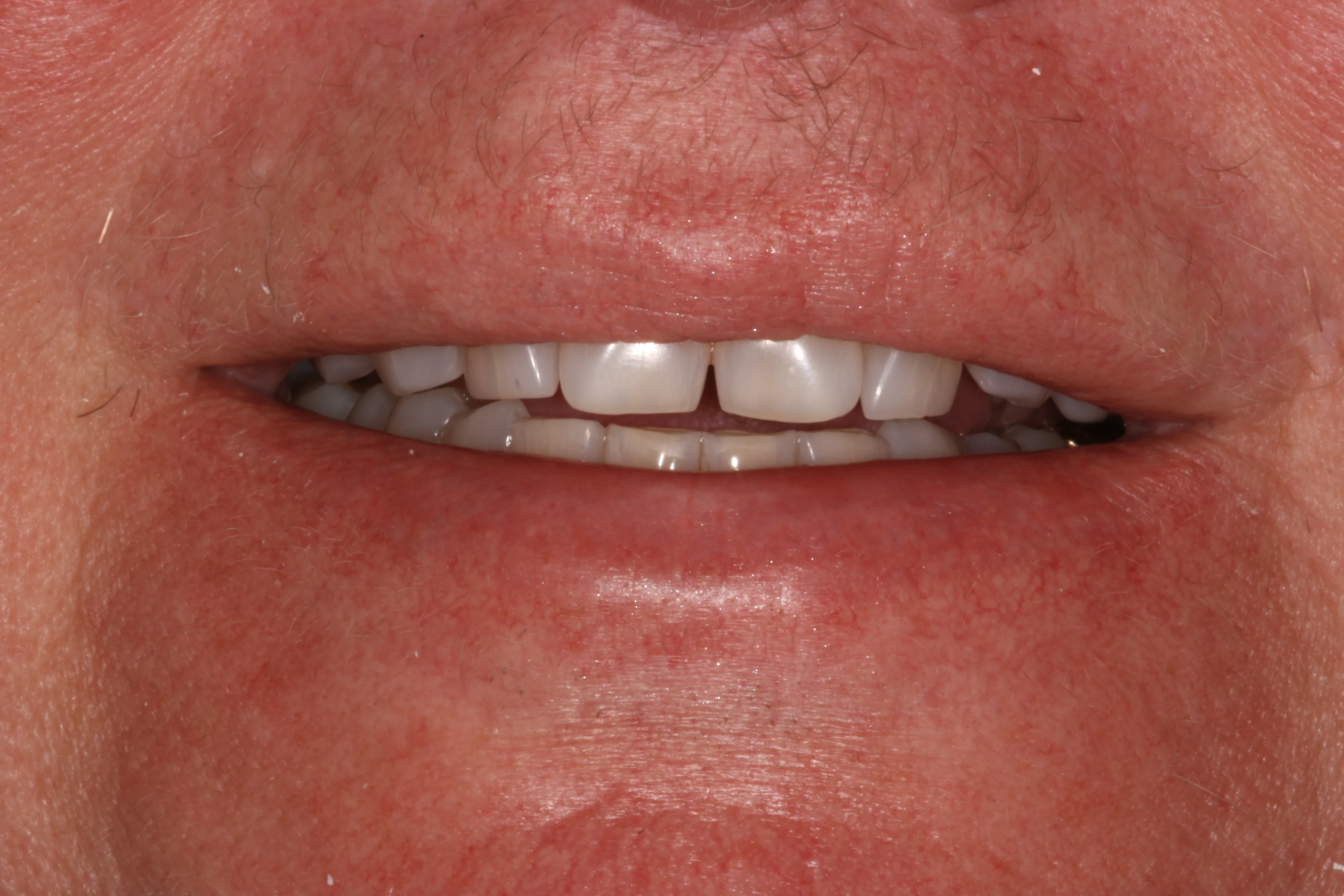 Before close up showing yellow worn teeth and spacing before veneer smile makeover