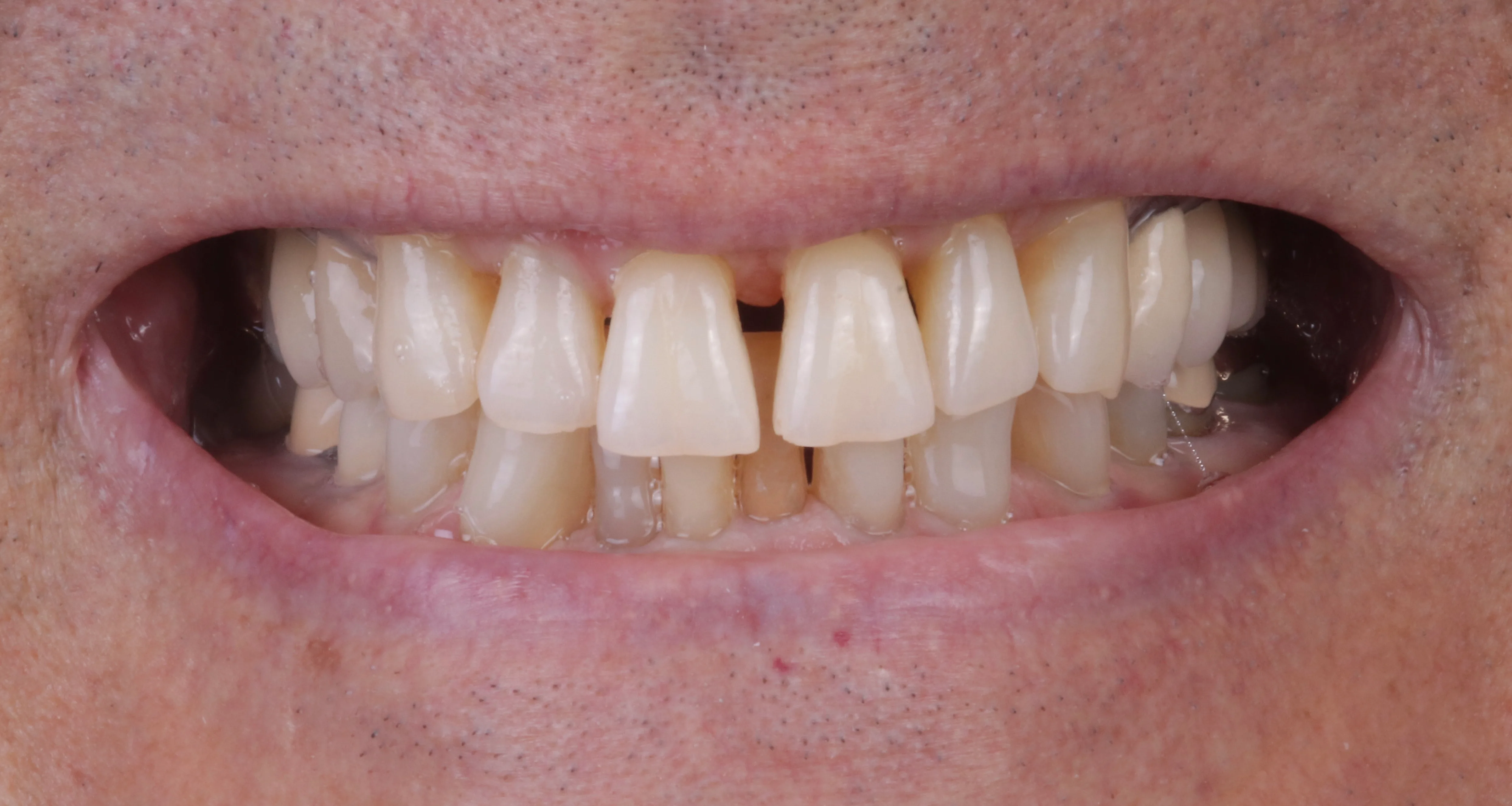 Before close up showing severe spacing wear and uneven teeth before cosmetic smile makeover